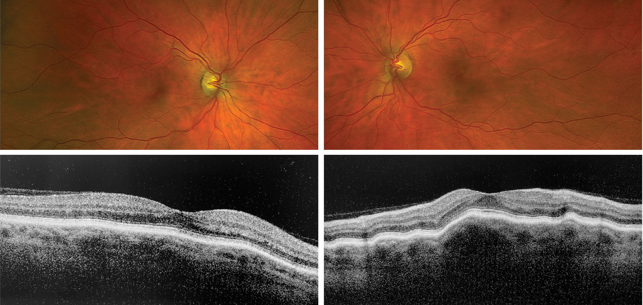 What do these findings suggest about the patient? How would you approach management?