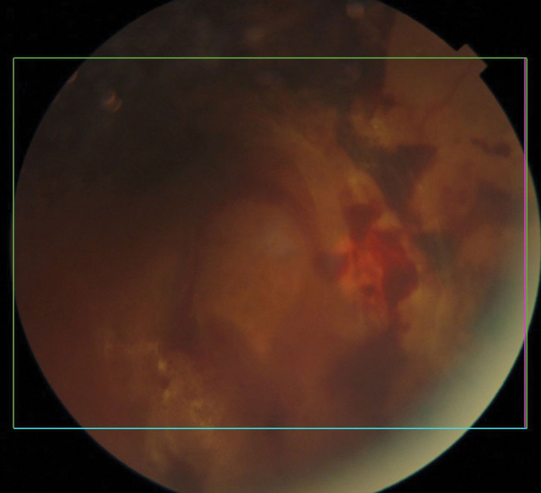 Diabetic retinal and vitreal hemorrhages.