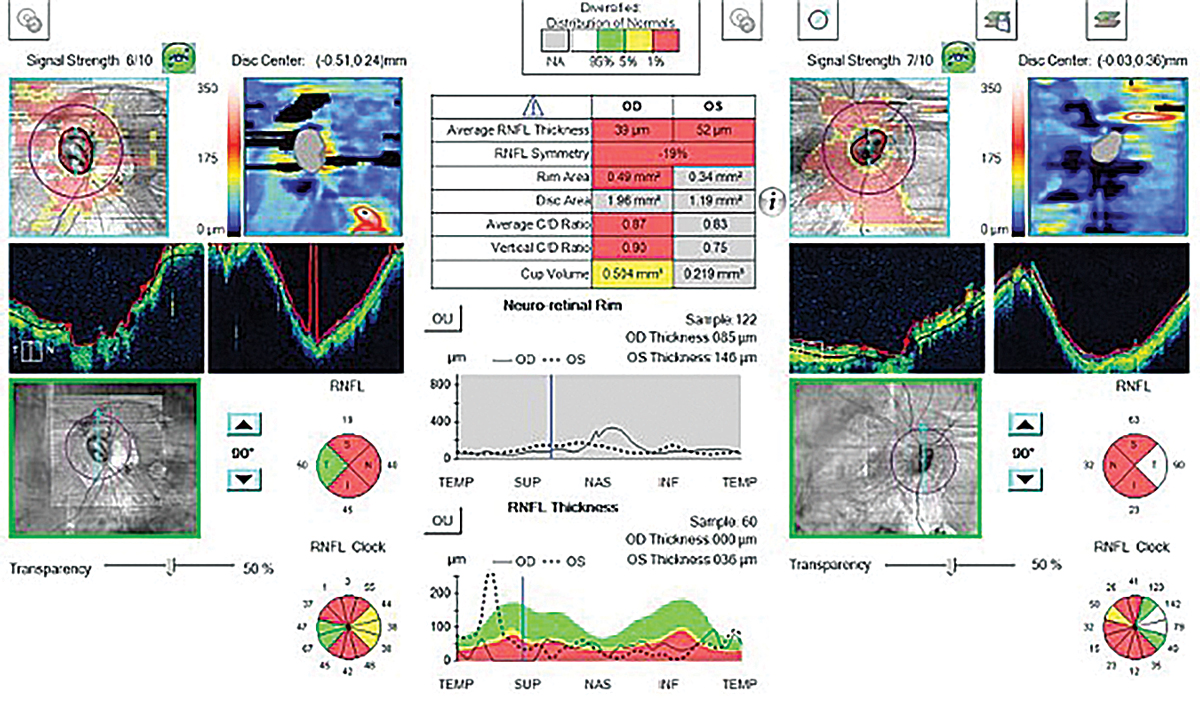 Fig. 4. This abnormal OCT shows poor segmentation in both the heat maps and tomograms in a high myope. The statistical analysis shows “red,” meaning abnormal thinning; however, this isn’t due to glaucoma but rather is from poor segmentation caused by high myopia.