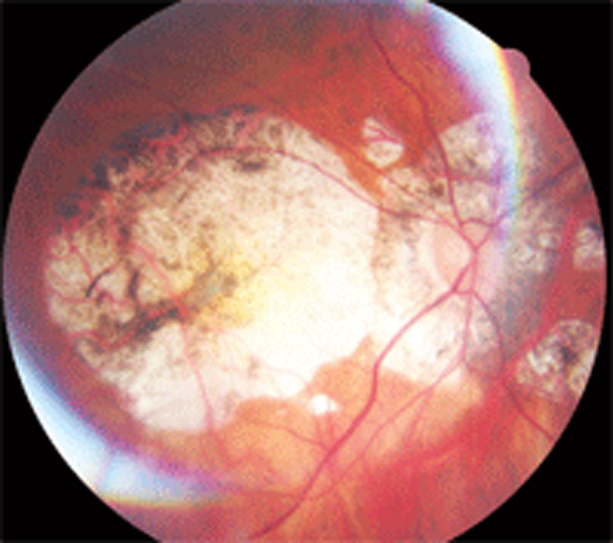 Myopia development and progression may be more common in young adults than was previously thought.