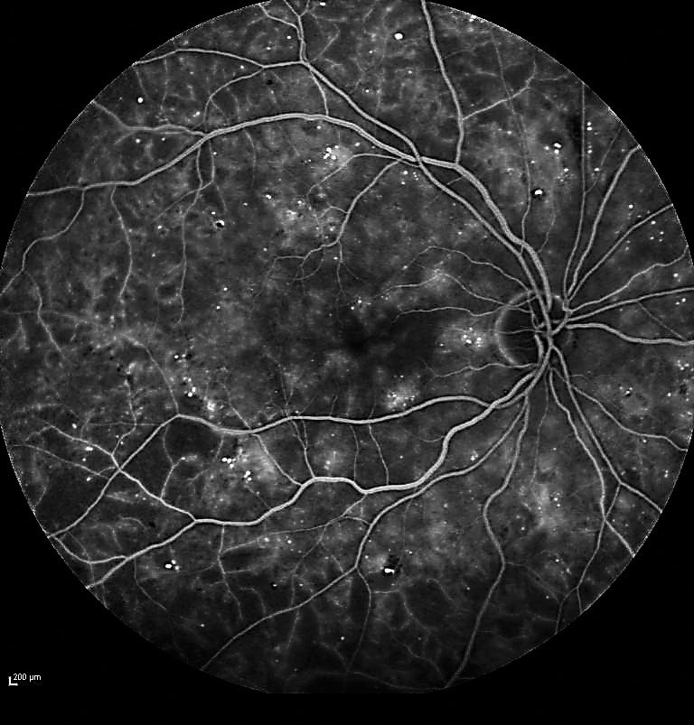 DR patients were observed in this study to have thinner choroids before the disease progressed to PDR.