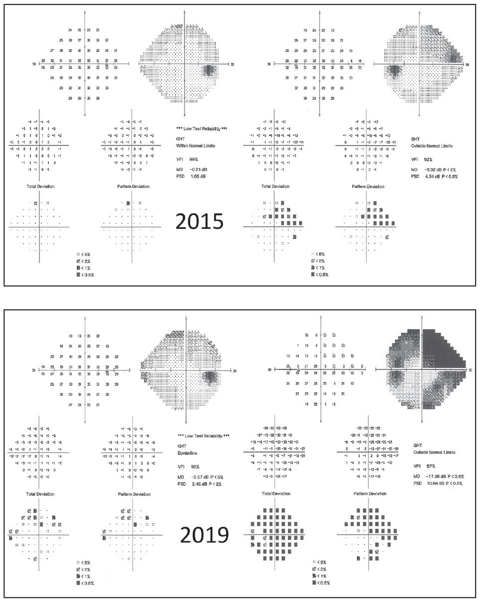 This study found that trend analysis of visual field (VF) global indices may not entirely accurate for measuring rate of progression.