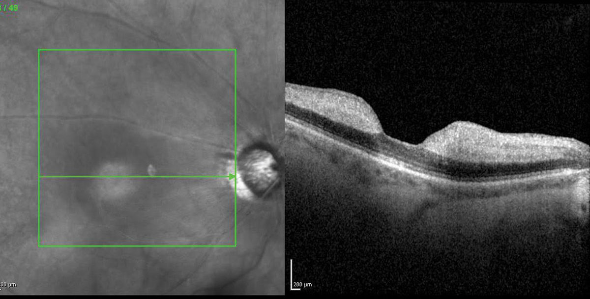 Patients with RAO are at increased risk of stroke and must be more urgently referred to stroke centers (pictured: CRAO).