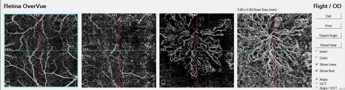 OCT-A may be able to shed light on exudation recurrence in neovascular AMD.