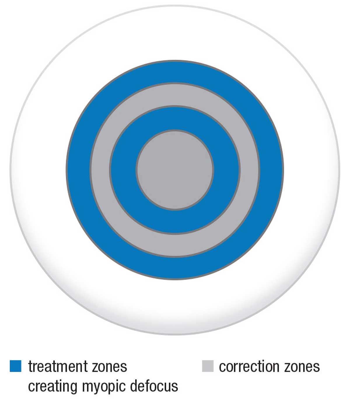 The MiSight lens by CooperVision is a dual-focus contact lens, an option which could help slow myopia progression.