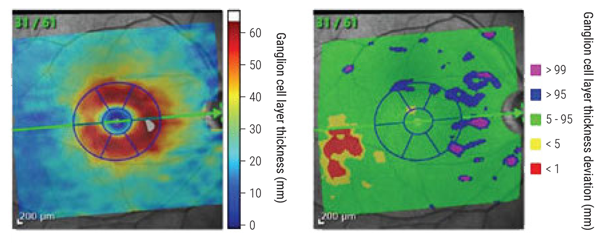 Macular GCL thickness may be a useful parameter in the evaluation of glaucoma progression.