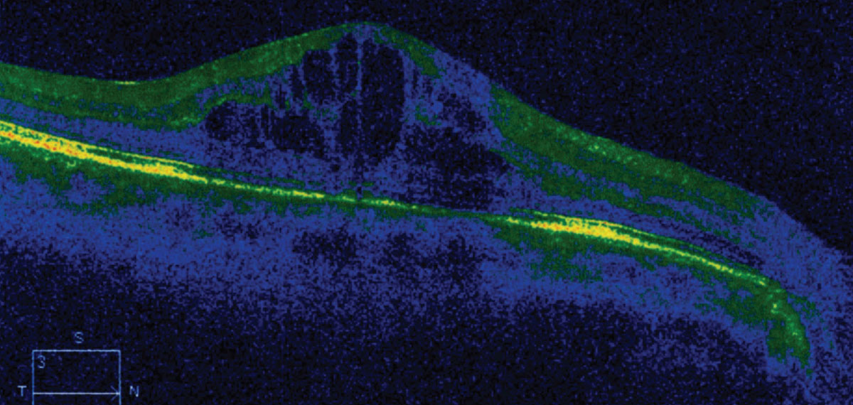 Complications from cataract surgery have become more common since the pandemic begun and reduced the number of patients undergoing the procedure. 