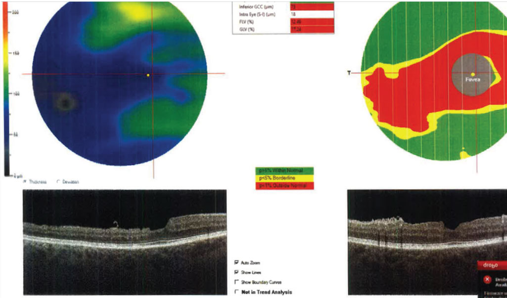 Lower baseline superficial—but not deep—parafoveal vessel density was correlated with ganglion cell complex thinning in this study. 