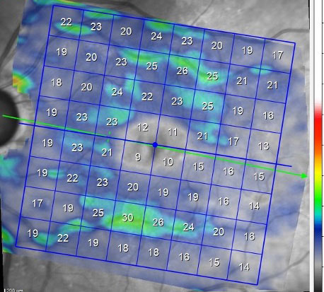 Note the paucity of the ganglion cell layer in the macula OS.