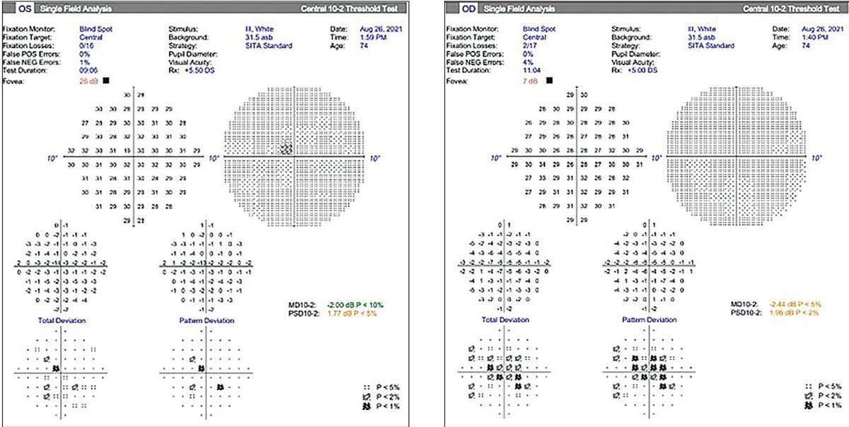 Figs. 4 and 5. Standard Humphrey 10-2 visual fields were performed and show a central depression in both eyes. Does this represent artifact or is it a real defect?