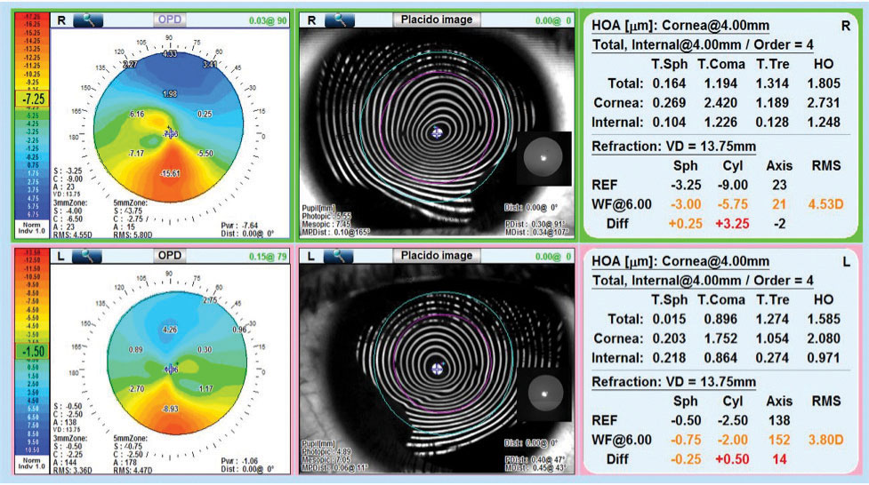 This study found a possible connection between HOAs and high myopia development.