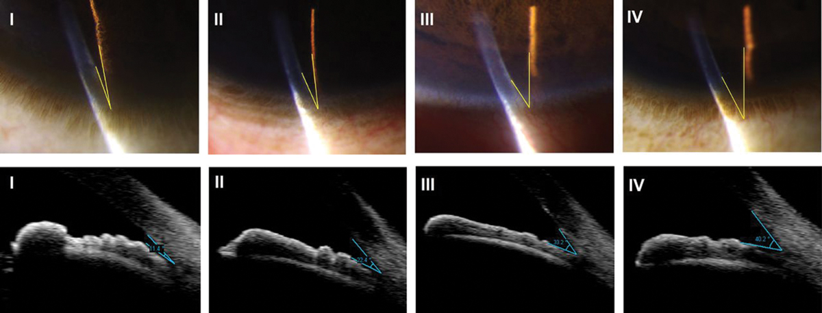   An assessment of the anterior chamber depth using the Van Herick method and grading system. This is a quick screening method to estimate anterior chamber depth. 