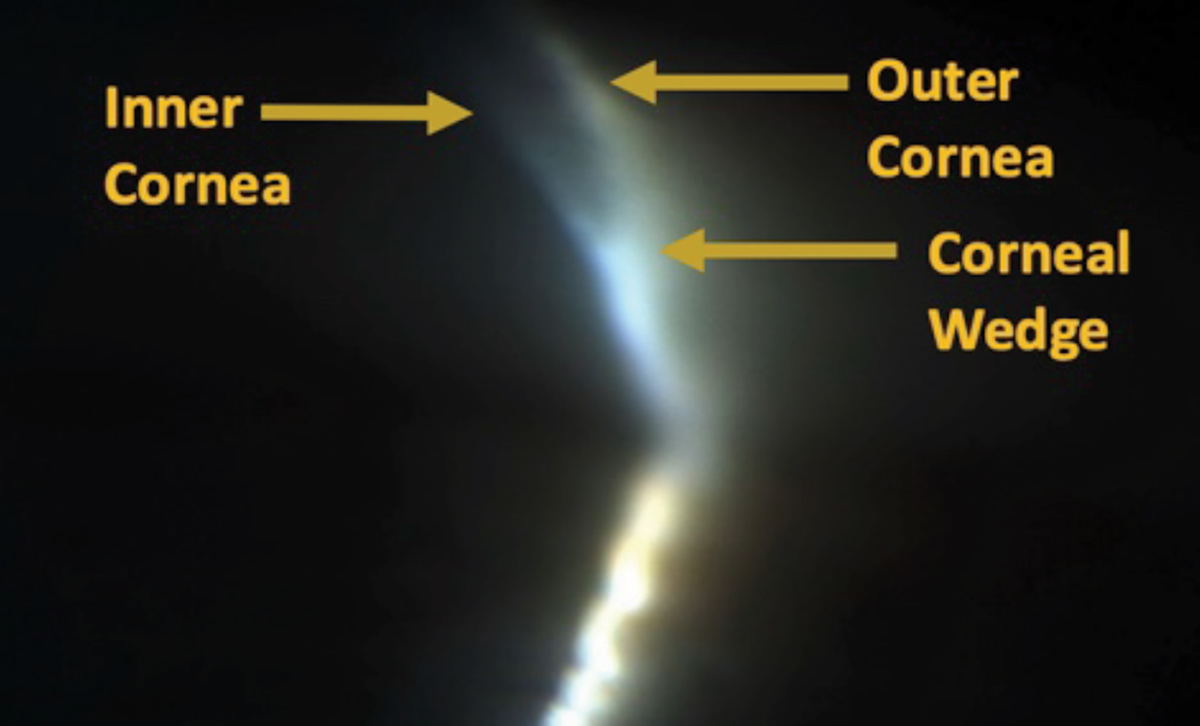 Slit lamp image of a corneal wedge through gonioscopy helps identify the anterior most portion of the angle.