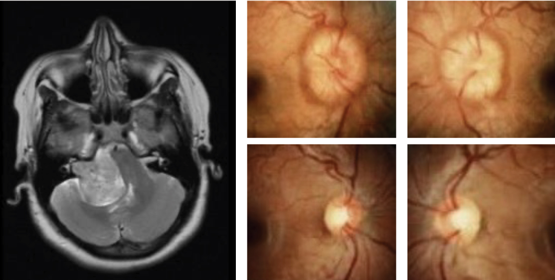 This patient presented with papilledema and was diagnosed with IIH following lumbar puncture and negative MRI/MRA. After treatment with oral acetazolamide, complete resolution of disc edema is noted with some degree of secondary disc pallor.