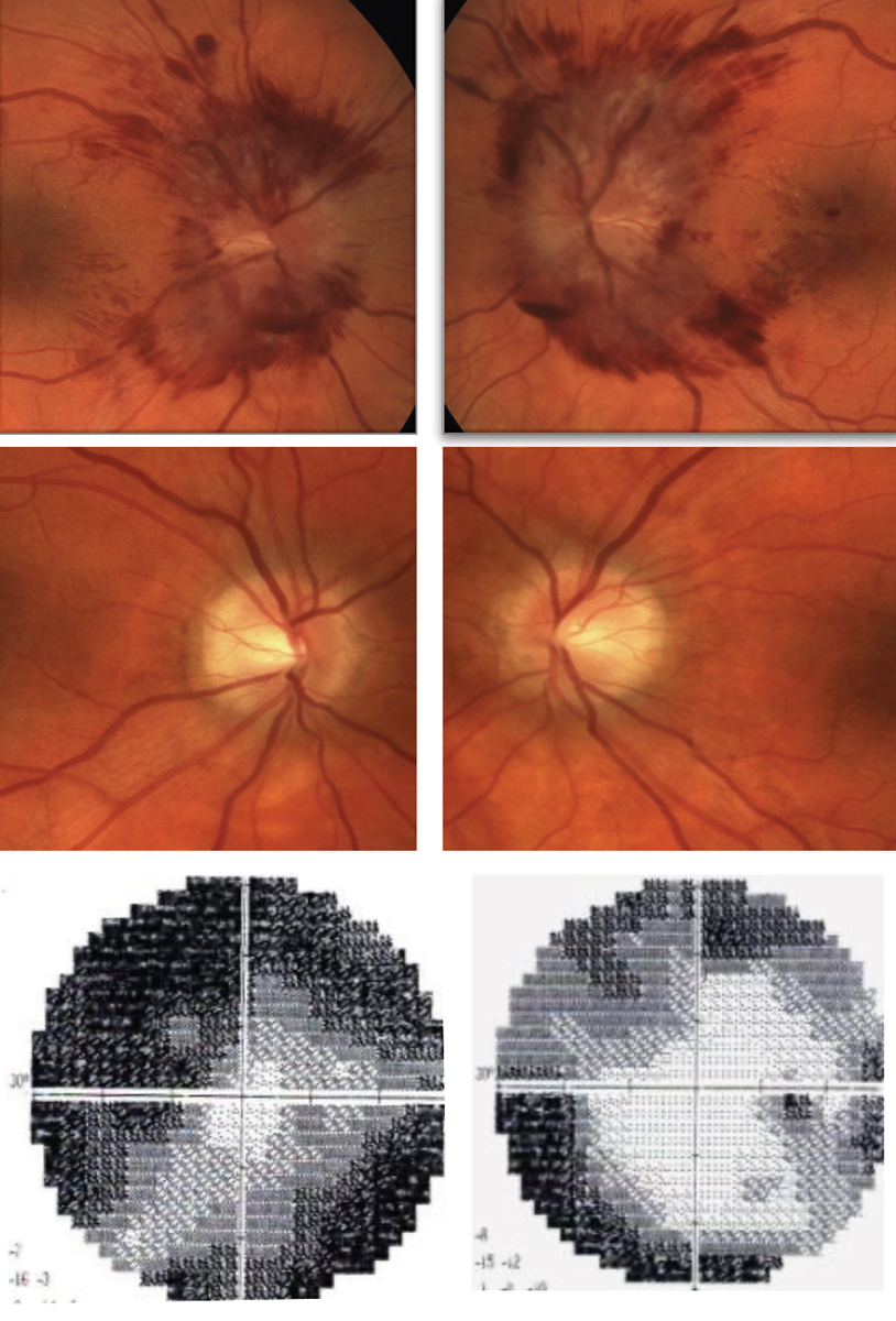 This pregnant female patient presented with pre-eclampsia. Following optimal treatment and improvement of blood pressure, resolution of hemorrhagic papilledema is noted with secondary disc pallor. On the bottom right is a typical visual field finding associated with papilledema. The degree of visual field suppression is secondary to the severity of disc involvement. 