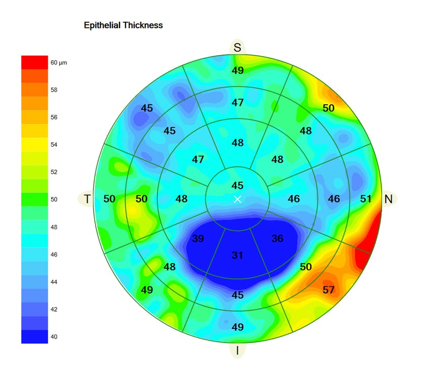 Patients with different types of astigmatism (characterized by the orientation of the steepest corneal meridian) had varying epithelial thicknesses in this study. 