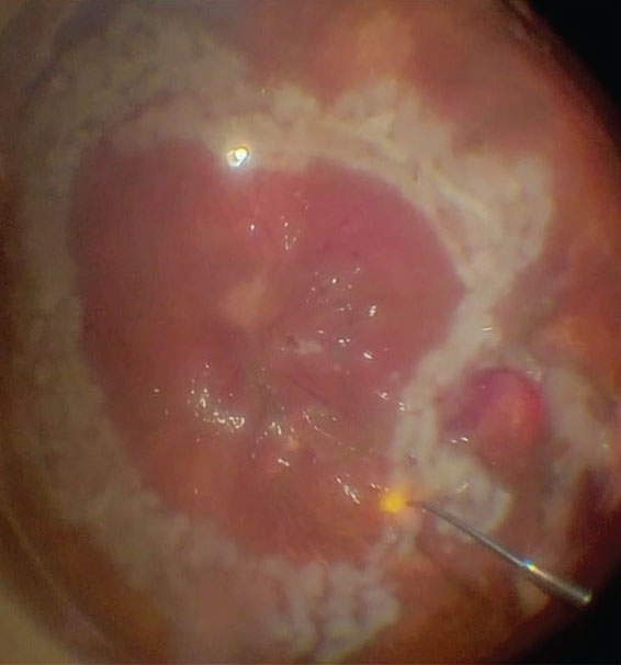 This study population's visual acuity improved six months after PPV.