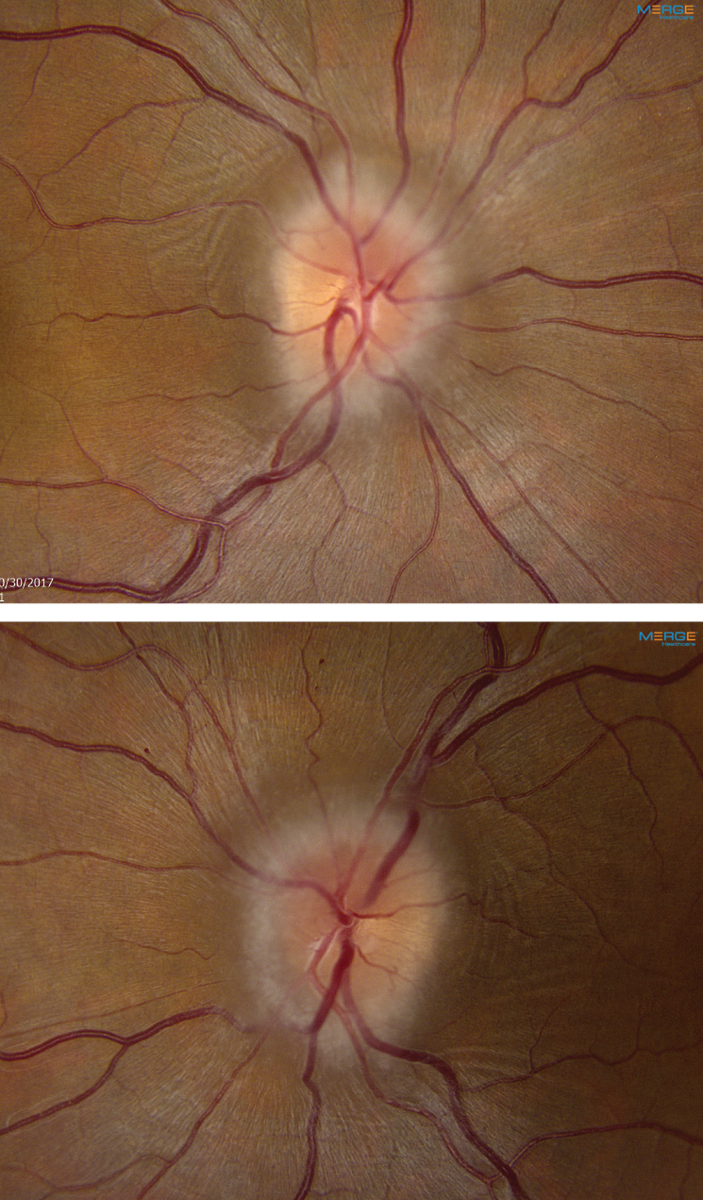 Papilledema patients who are asymptomatic may still have IIH progression.