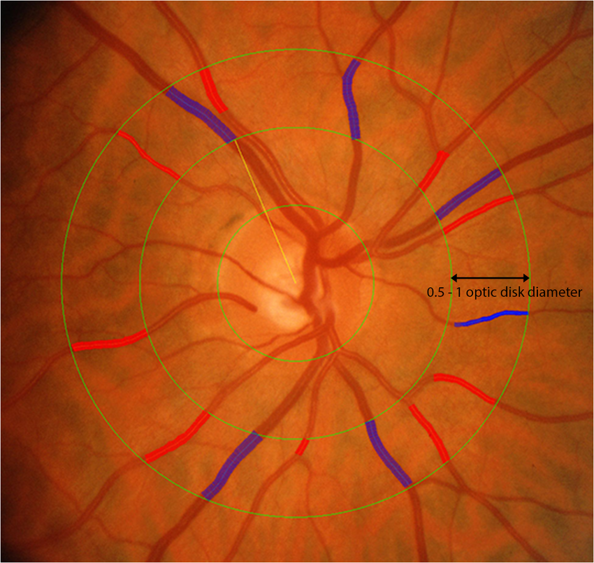 Techniques to measure arteriole (red) and venule (blue) diameter may one day become part of a protocol for cognitive assessment.