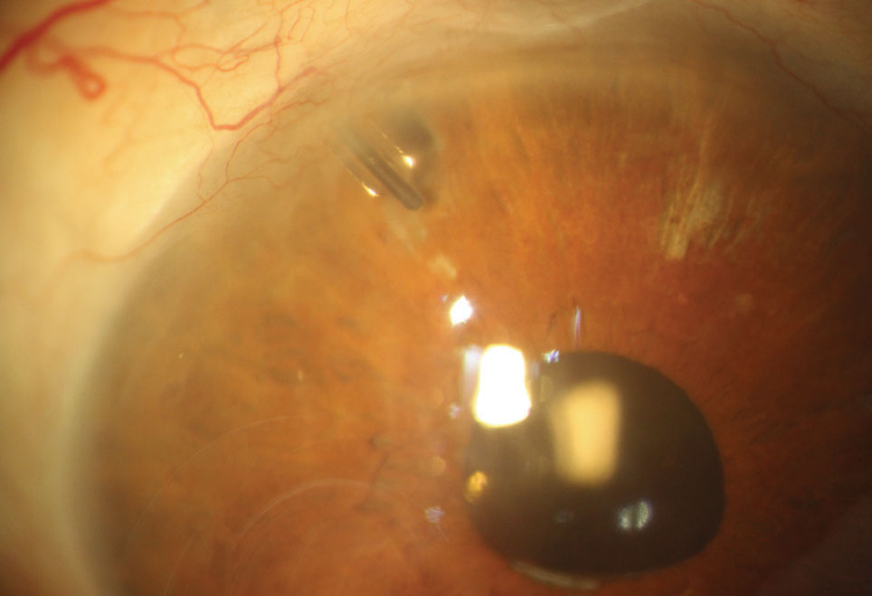 This study identified several risk factors for tube shunt failure. 