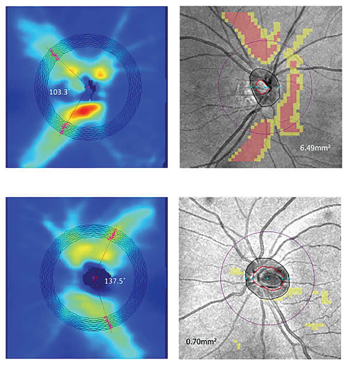 This new classification system for myopia patients may help identify those with glaucomatous damage or progression.