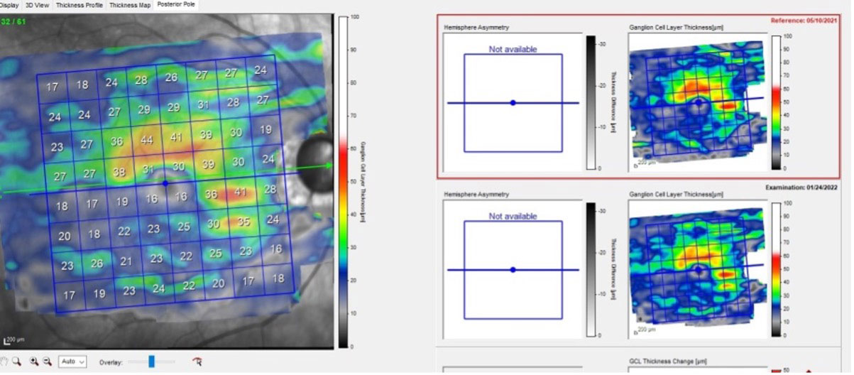 Subtle progression in ganglion cell layer loss in the other patient.