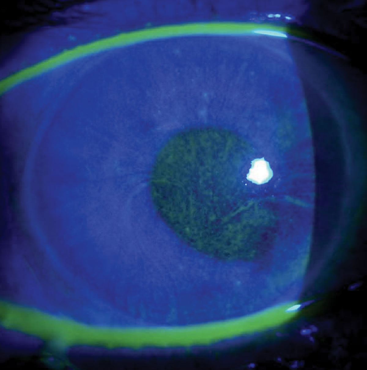 Case 3. This patient had uncontrolled IOP and a swirling pattern of NaFl staining.