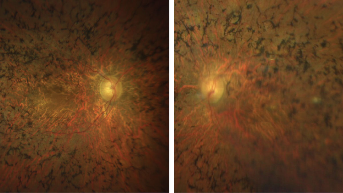 Figs. 3 & 4. Here is a closer view of the macula and posterior pole of our patient. How would you characterize the optic nerves?