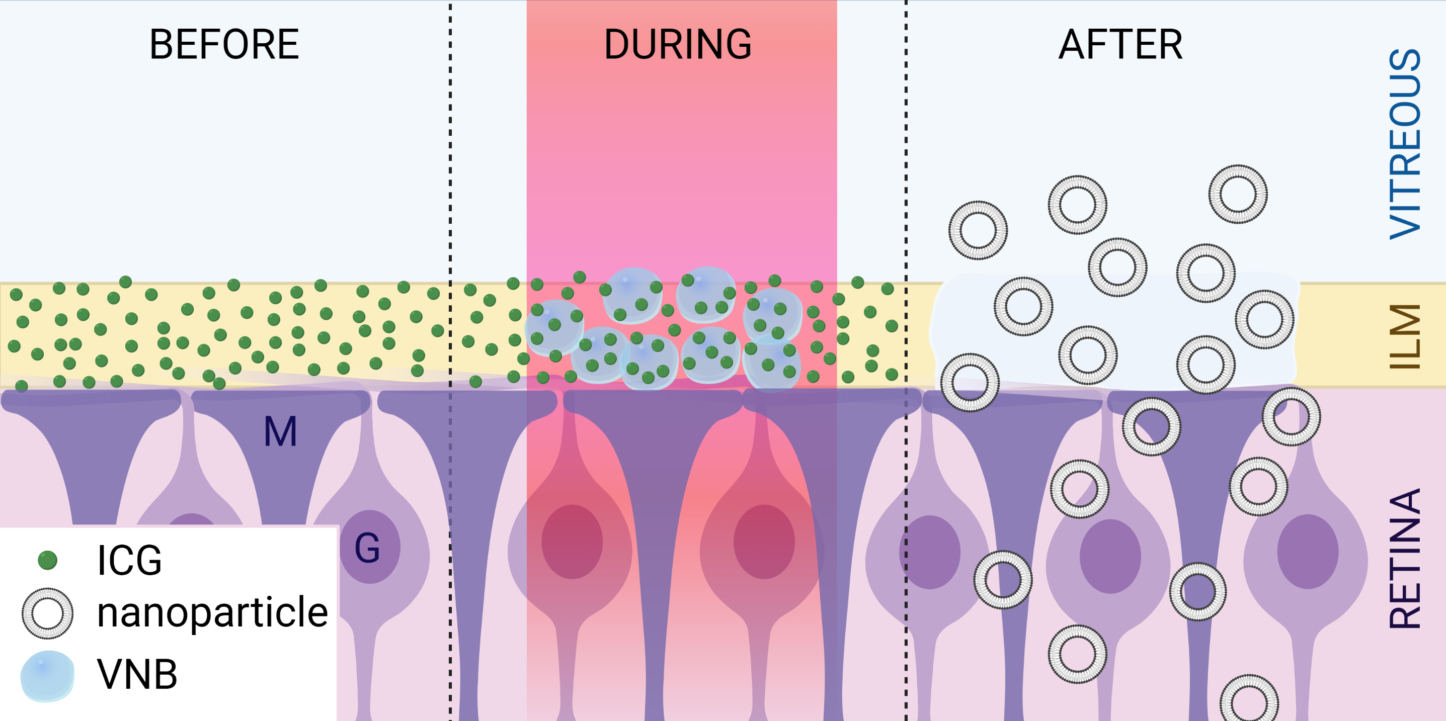 This study found that ICG-mediated photodisruption of the ILM may safely enhance nanoparticle delivery to the retina.