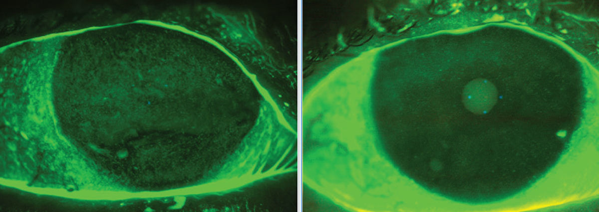 This dry eye patient experienced significant relief after approximately 12 weeks of blood-based treatment.