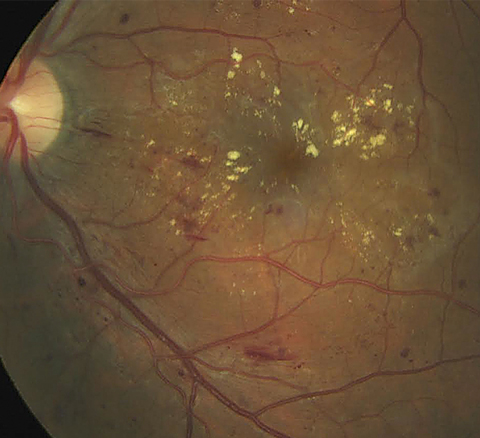 Macular edema patients who have worse VA in the better eye may be more likely to have a lower quality of life. 