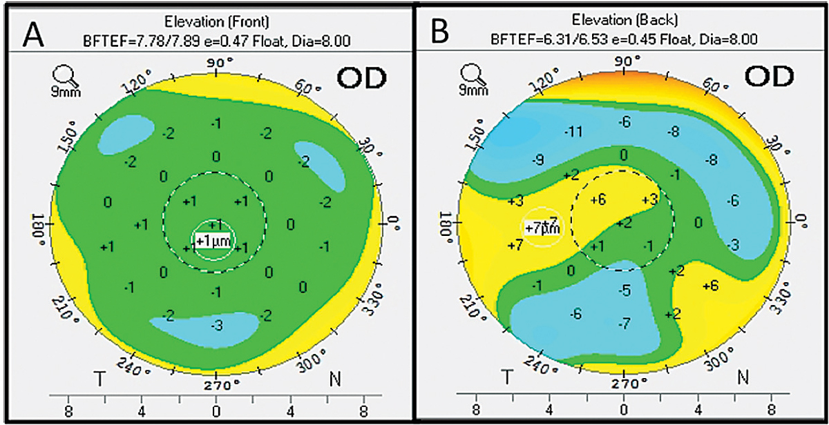 Researchers noted that caution should be used when interpreting suspected elevation maps of potential refractive surgery candidates who don’t have any clinical or topographic aspects of keratoconus.