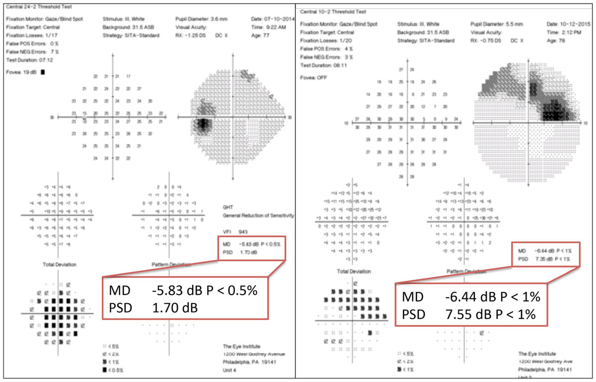 10-2 and 24-2 visual field tests can be used in conjunction to strengthen detection of glaucomatous damage.