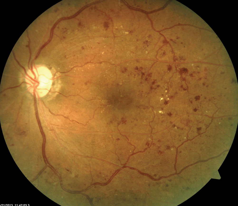 DR lesions tend to be distributed more peripherally in East Asian eyes compared with other ethnicities.