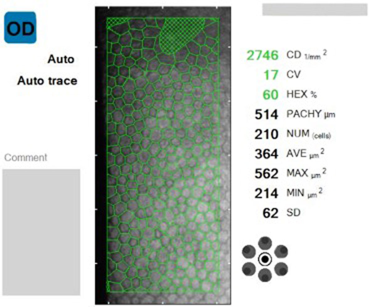 Fig. 3. Specular microscopy was performed in the patient’s fellow eye, revealing healthy endothelial cells without corneal edema. Endothelial cell analysis was attempted OS, but data was unable to be collected.