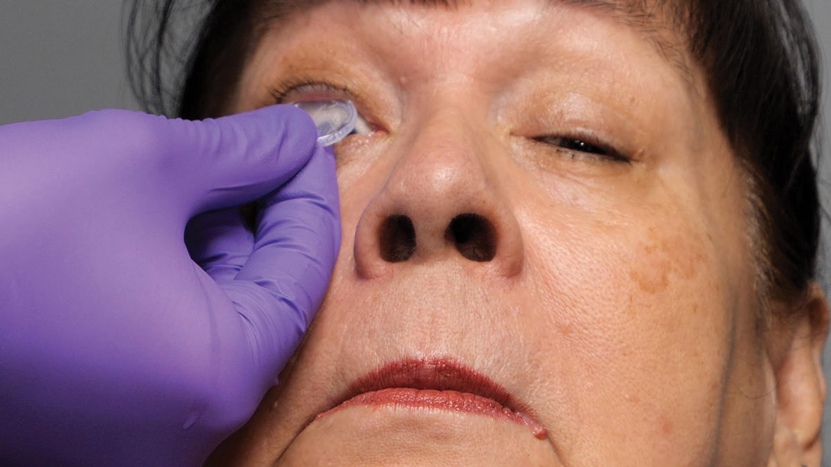 Fig. 3. Prokera Slim being inserted on a patient. It is a corneal bandage device that reduces inflammation, prevents scarring and helps the ocular surface heal.