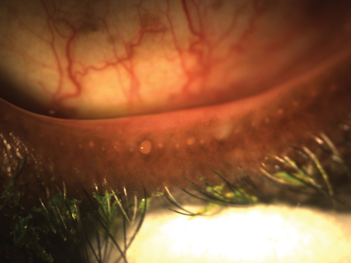 Fig. 4. Obstructed meibomian glands respond to digital pressure by releasing thickened, cloudy meibum.