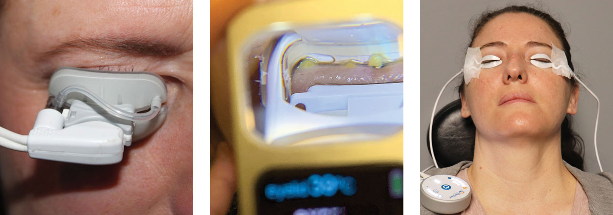 Fig. 5. In-office procedures to heat and express the meibomian glands yield many benefits. From left to right: iLux, LipiFlow and TearCare.