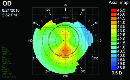 Bowtie topographic patterns are only one type of pattern seen in ectatic patients. 