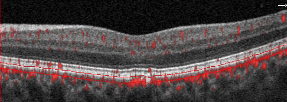 Researchers in this study found that quantitative cutoffs <20.5µm and <10.5µm for Sattler layer-choriocapillaris complex thickness were associated with a moderate and high probability of AMD progression.