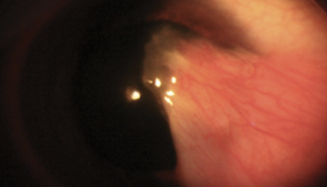 This new method of sustained drug delivery could help fight CNV in patients with various ocular conditions. 