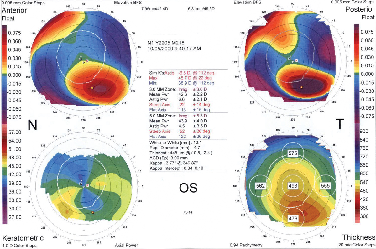 This study found that unilateral CXL may be an effective way to improve vision in the worst of two eyes with keratoconus.