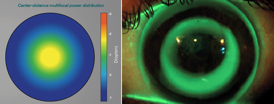 Multifocal soft contact lenses and ortho-K lenses both outperformed single-vision spectacles in terms of controlling myopia progression in children.