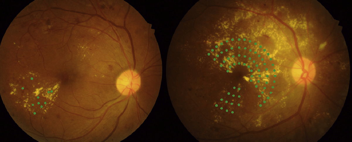 Focal (left) or grid (right) photocoagulation, when combined with anti-VEGF, allowed reduction of injection frequency.