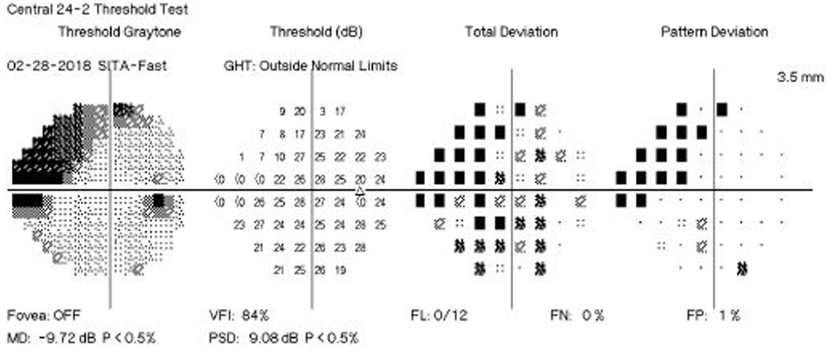 This study found a need in the United States for more frequent, consistent VF testing for glaucoma patients.