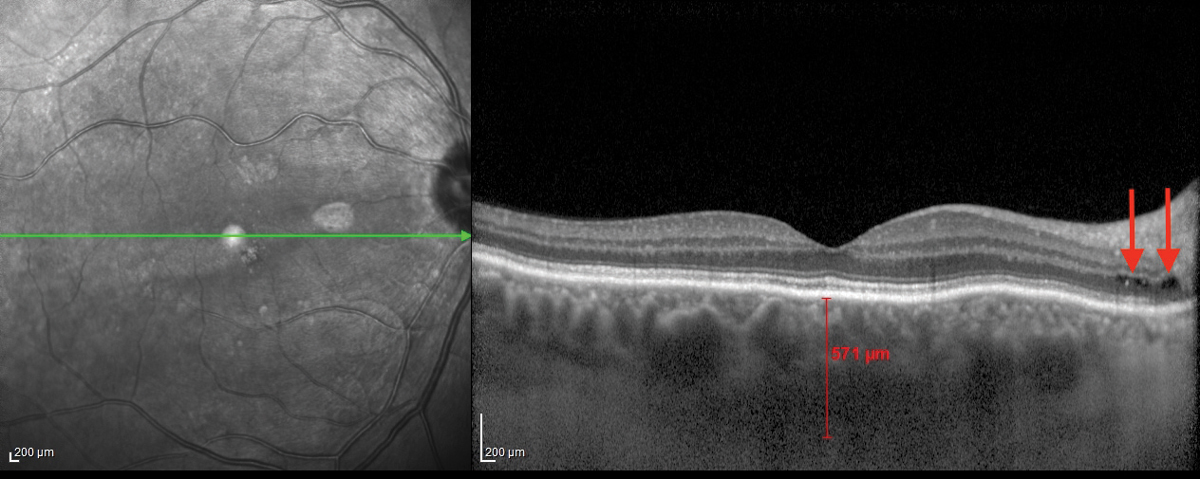 The coronavirus may cause some affected patients to have non-statistically significant retinal thickening and choroidal changes.