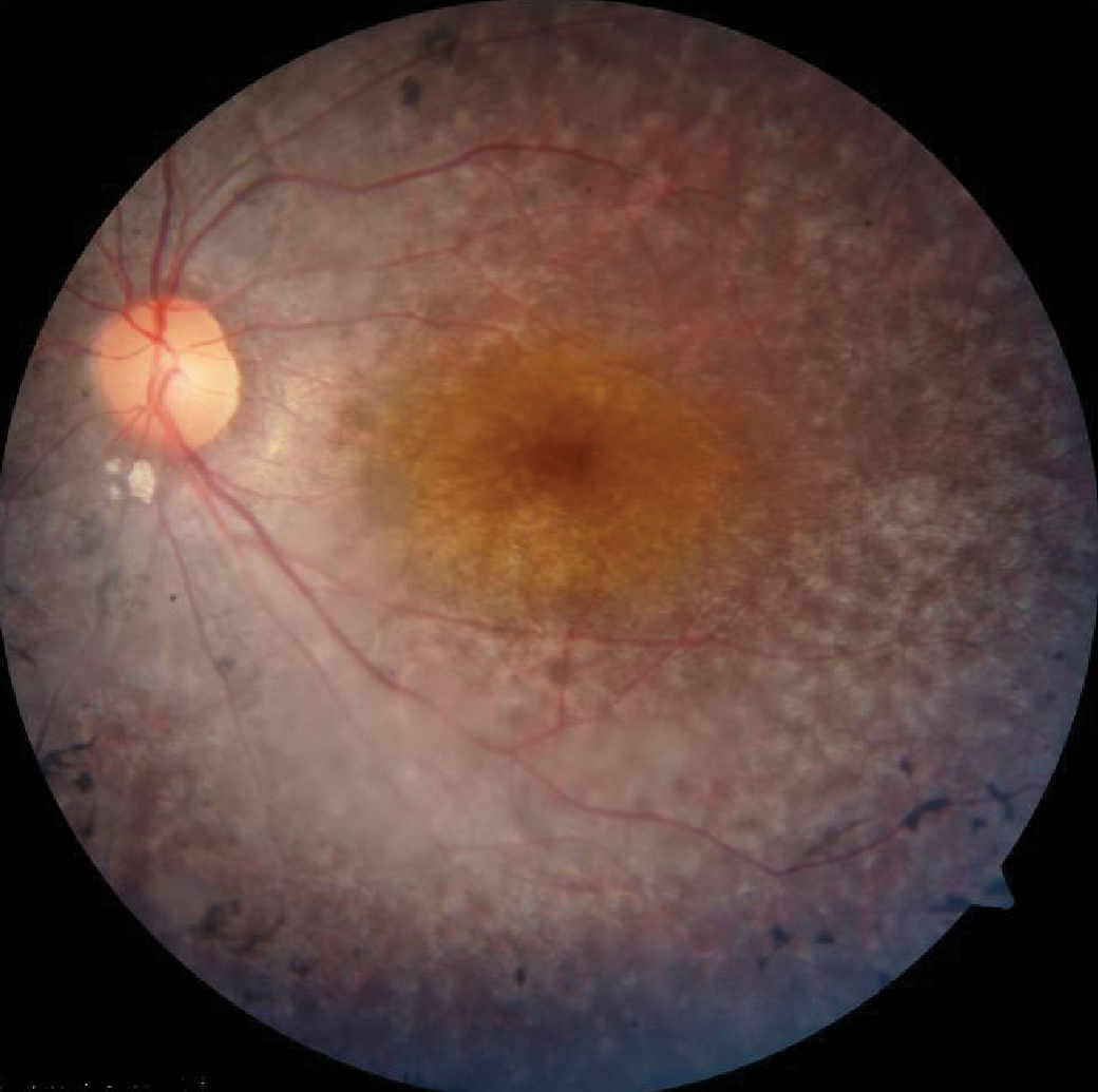 The hazard ratio of open-angle glaucoma is significantly greater in those with RP, so clinicians should pay more attention to the optic nerve. 