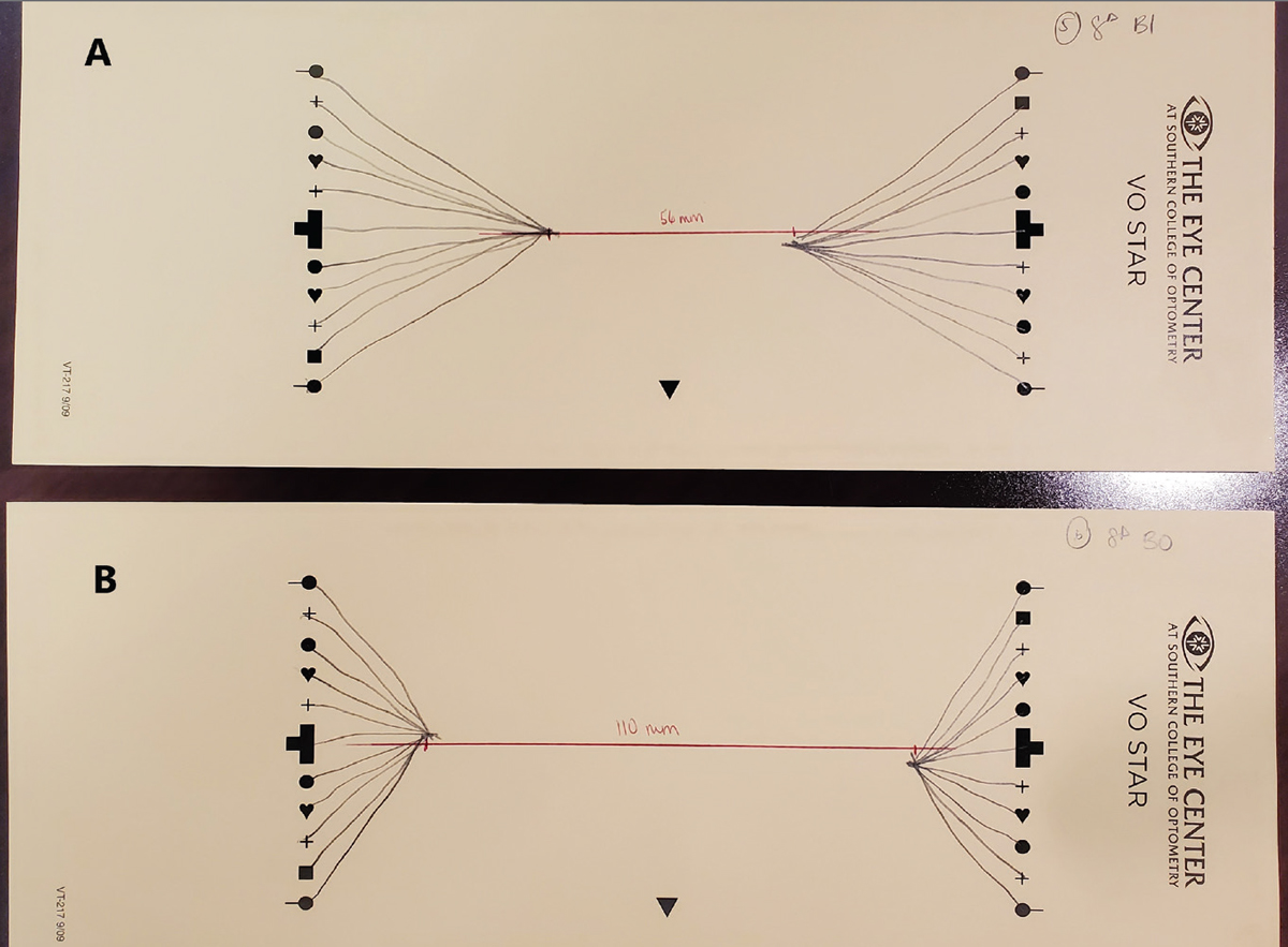 Fig 3. Van Orden stars with 8^ base-in (A) and 8^ base-out (B). The prism’s influence is evident in the significant horizontal shift of the apices.