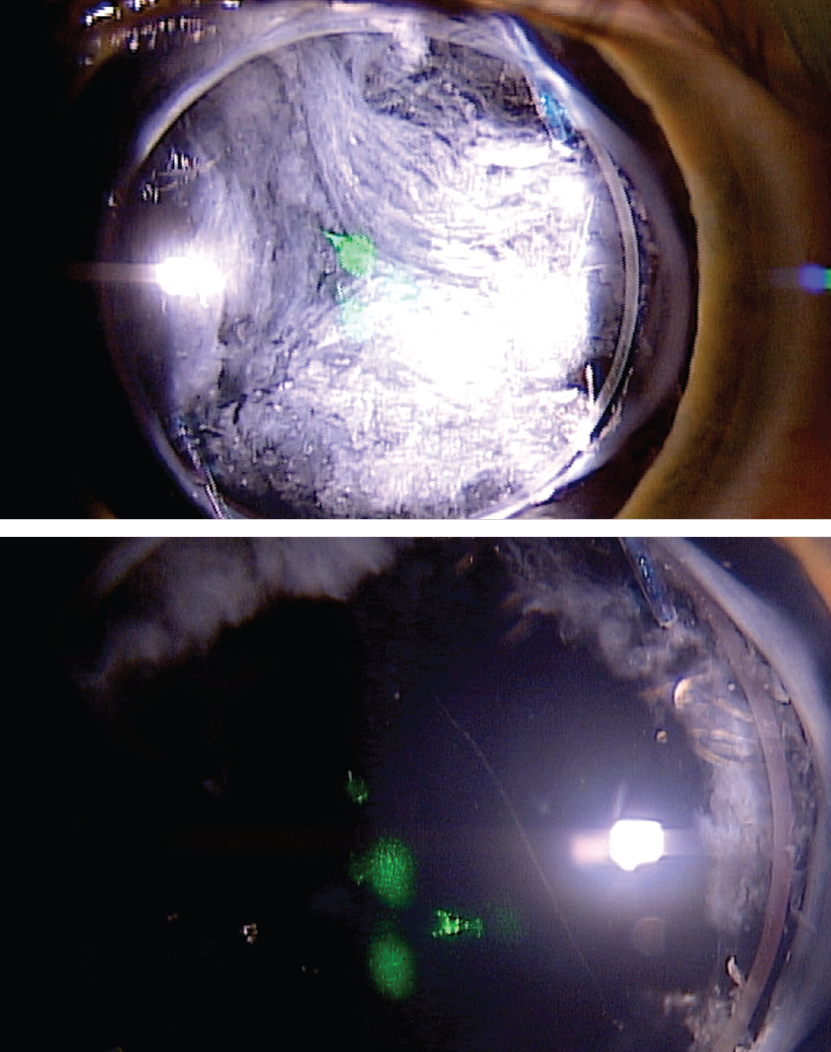 Another patient before (top) and after (bottom) YAG posterior capsulotomy.