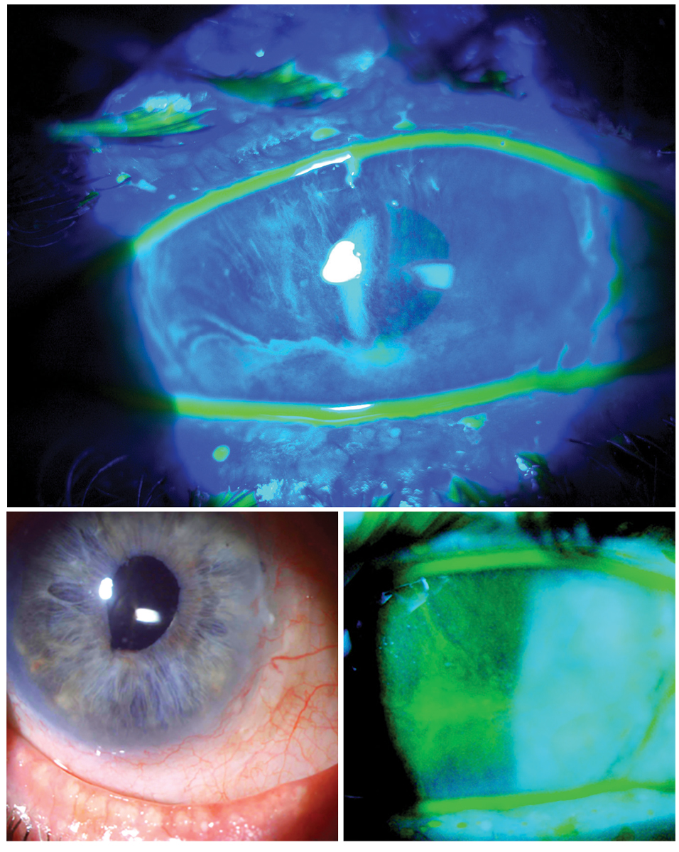 Structural concerns such as limbal stem cell deficiency may require a highly customized fit.